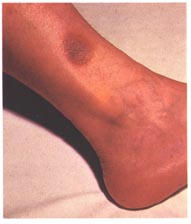 A fixed drug eruption shown as a sharply defined, dusky red patch of skin caused by a medicine, the kind of reaction that recurs at the same spot with each dose.